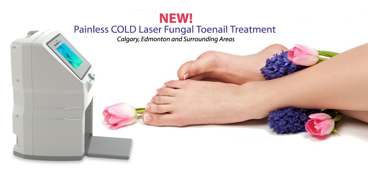 Fungal Nail Cold Laser Treatment Edmonton