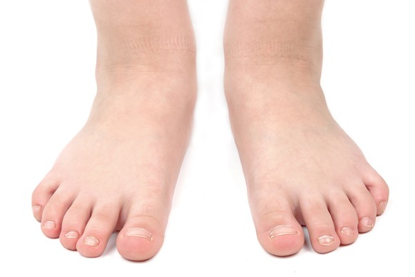 Problem Children's Feet Treatment Alberta