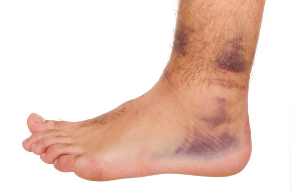 Foot and Ankle Injury Treatment Alberta
