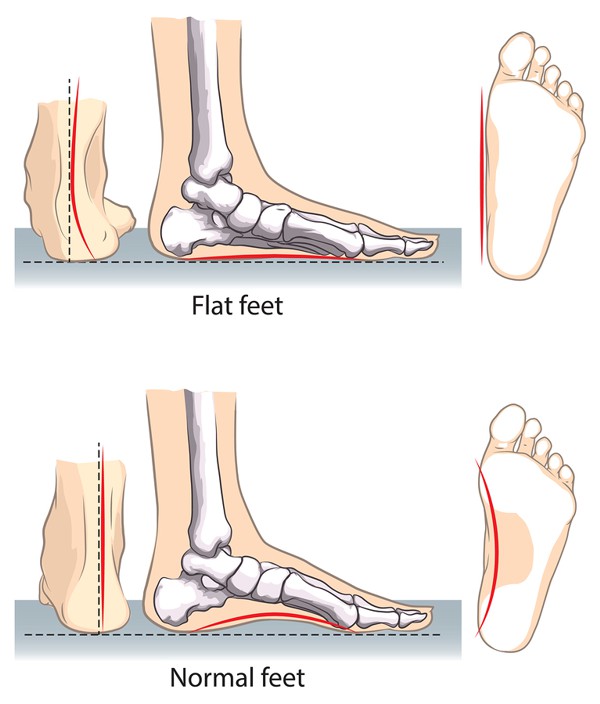 Flat Feet Treatment edmonton Treatment Alberta