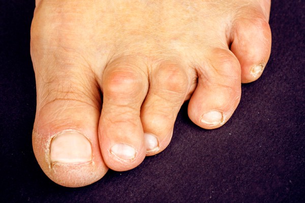 Can Hammertoes Be Dangerous?: Premier Foot and Ankle Center