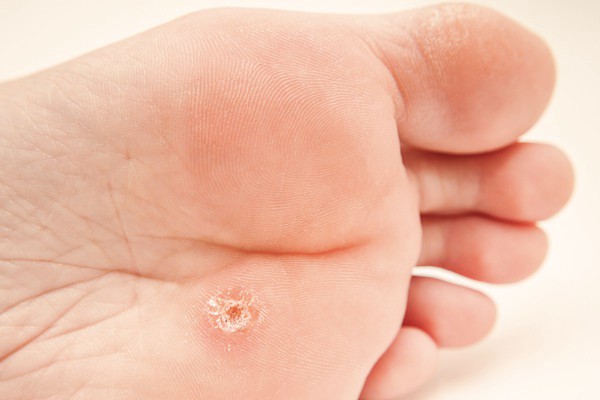 Wart treatment edmonton, Wart on foot 4 year old, Cancer of uterine symptoms